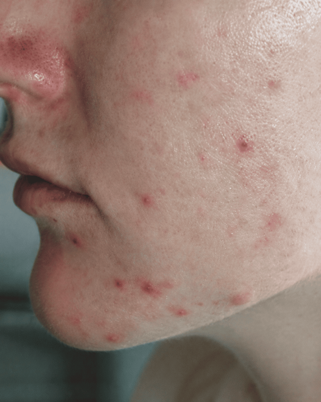 Post-blemish marks before, example three